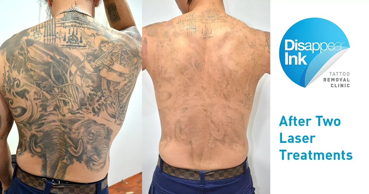 Expert Surgical Tattoo Removal | From £595 | UKSKIN