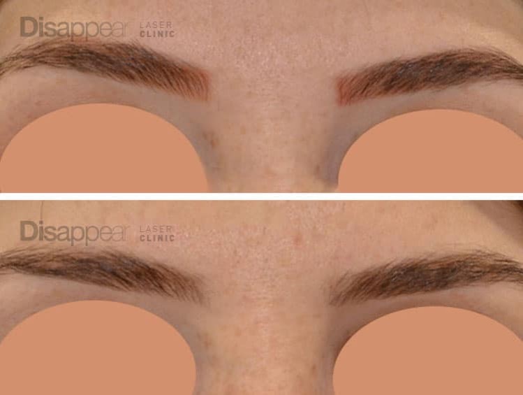 Disappear Laser Clinic + Tattoo Removal - Eyebrow Tattoo Before & After