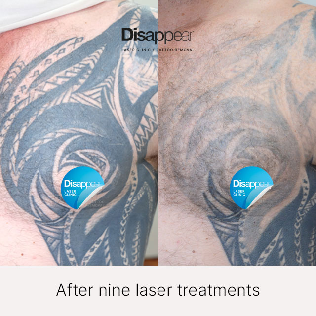 After Nine Treatments